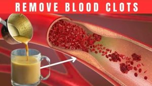 1 Cup a Day and You Will Never Get a Blood Clot Turmeric and Ginger Drink