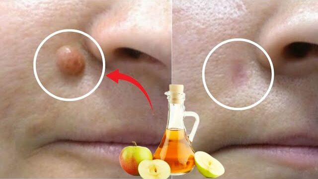 APPLE VINEGAR Removes WARTS in 24 HOURS! Just Do This